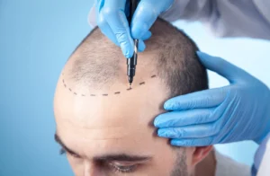 Hair Transplant Malpractice Turkey